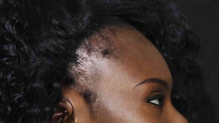 Rezultate Toppik inainte-dupa - femei