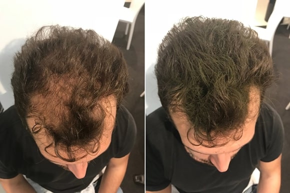 Rezultate clienti Toppik - barbati