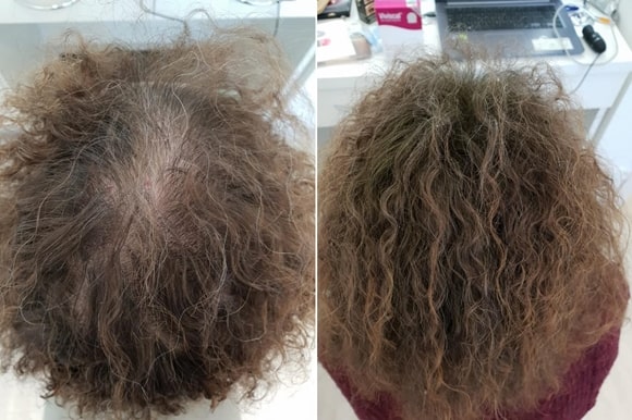 Rezultate clienti Toppik - femei