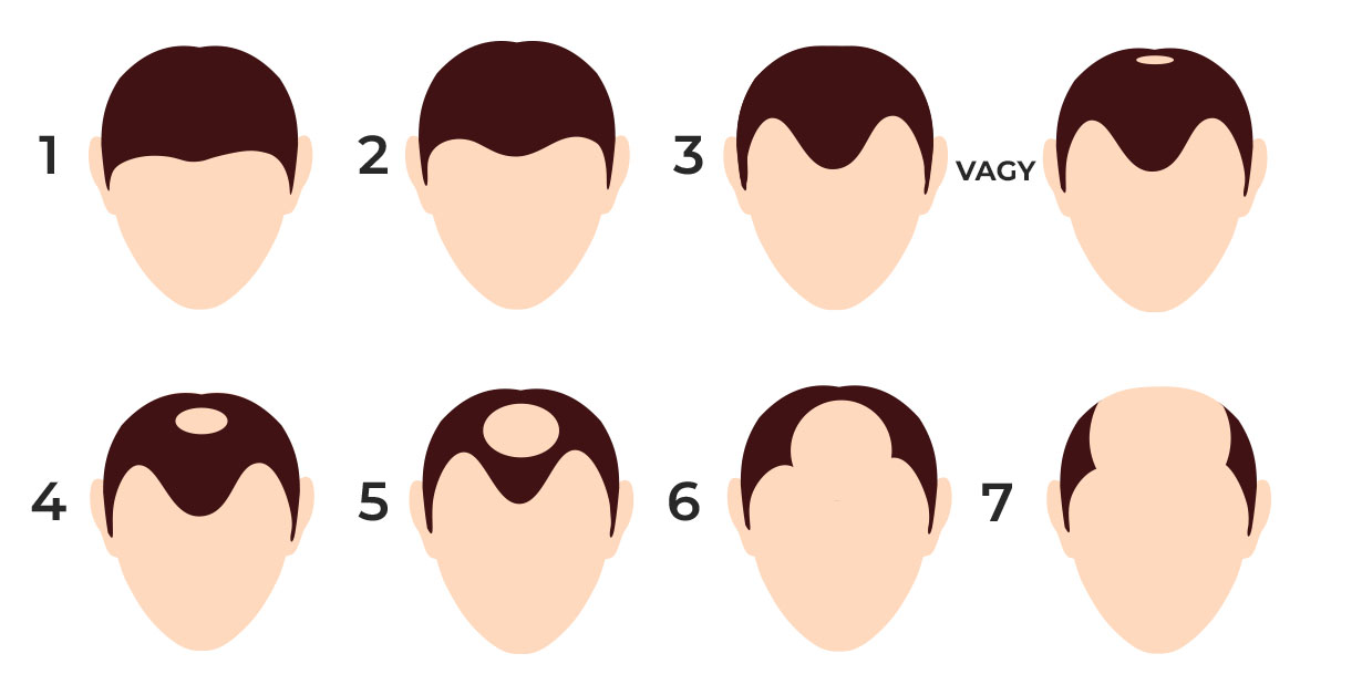 ALOPECIE-ANDROGENETICA-CADEREA-PARULUI-DE-TIP-MASCULINFEMININ